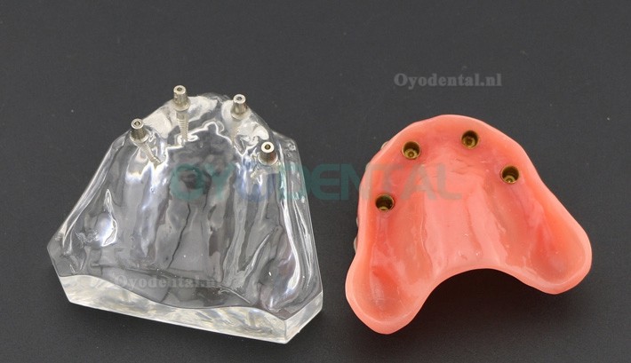 Tandheelkundige studie Tanden Model Overdenture met 4 implantaten Demo Model 6001